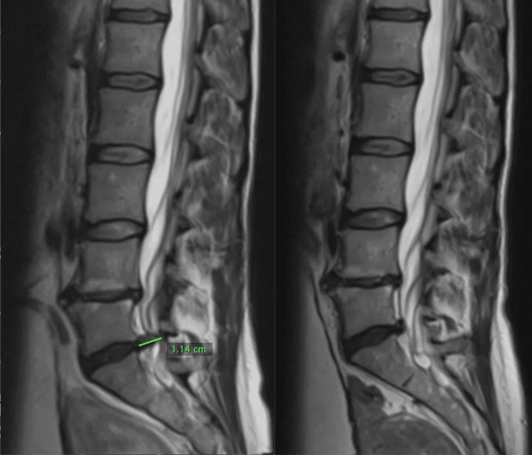 RMN de hernia discal L5-S1 — corte sagital antes y después del tratamiento regenerativo