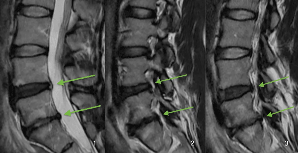 RMN colonna vertebrale — trattamento rigenerativo