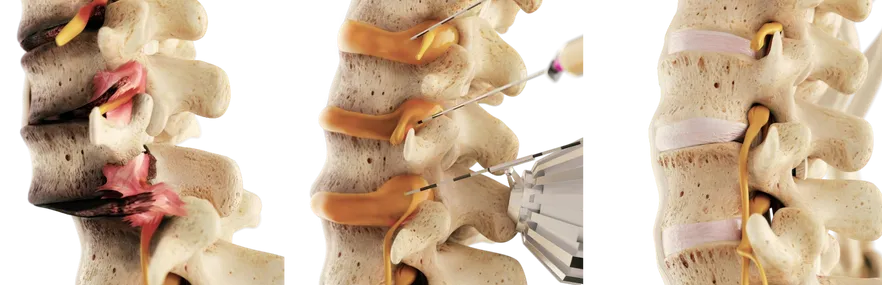 Tratamiento de la columna vertebral mediante el método regenerativo
