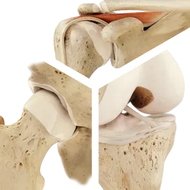 Tratamiento de la articulación de la cadera