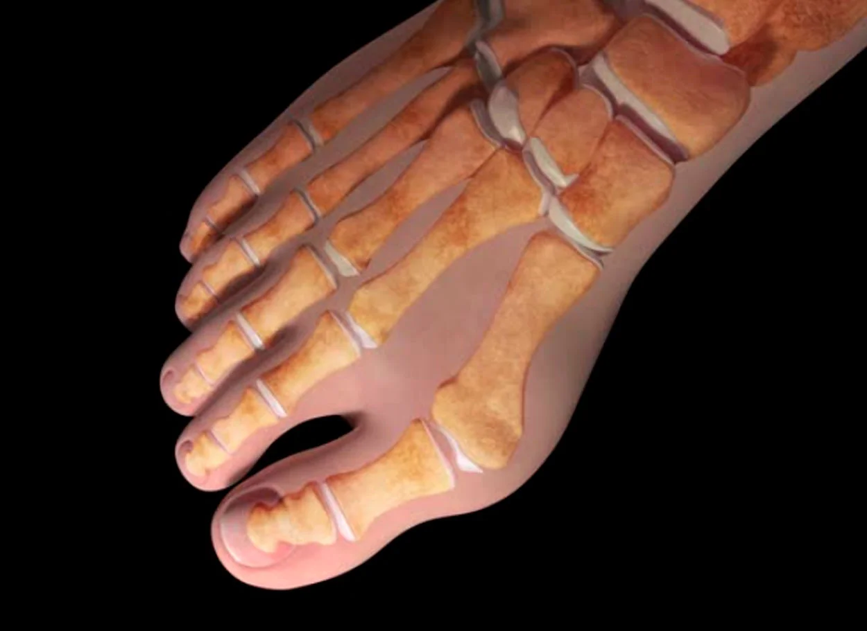 Hallux valgus — tratamiento regenerativo